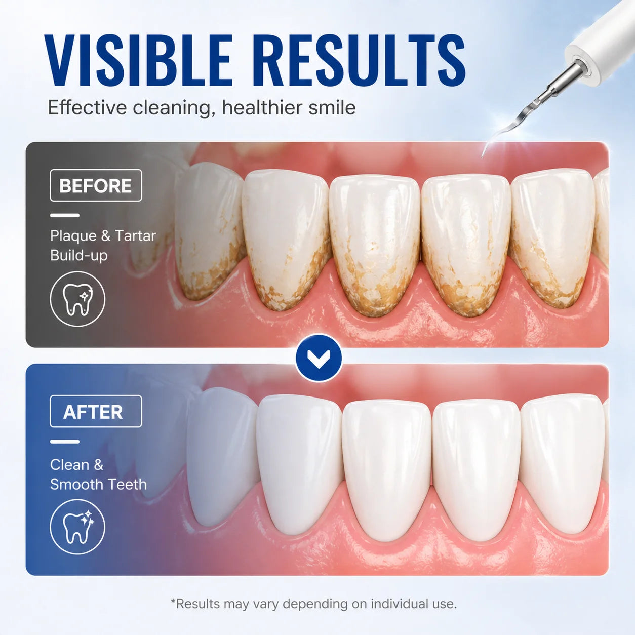 Ultrasonic Dental Scaler Electric Teeth Cleaner Sonic Teeth Plaque Cleaner Dental Stone Removal For Tartar Stain Cleaning Tools Zpaxo