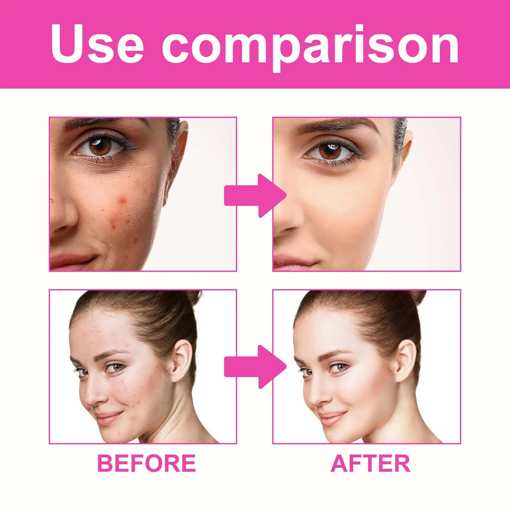Pimple Patches for Face Cute Butterfly Shaped Acne Patches Hydrocolloid Cute Zit Stickers Parches Para Acne Zpaxo
