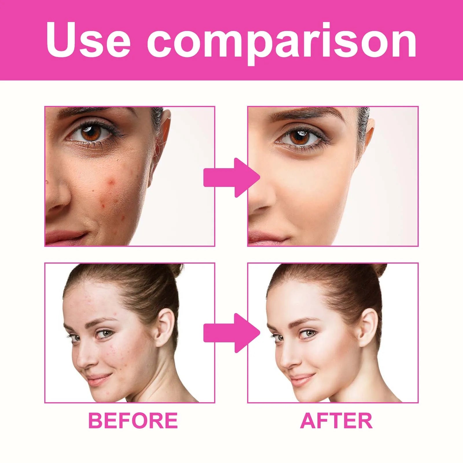 Pimple Patches for Face Cute Butterfly Shaped Acne Patches Hydrocolloid Cute Zit Stickers Parches Para Acne Zpaxo