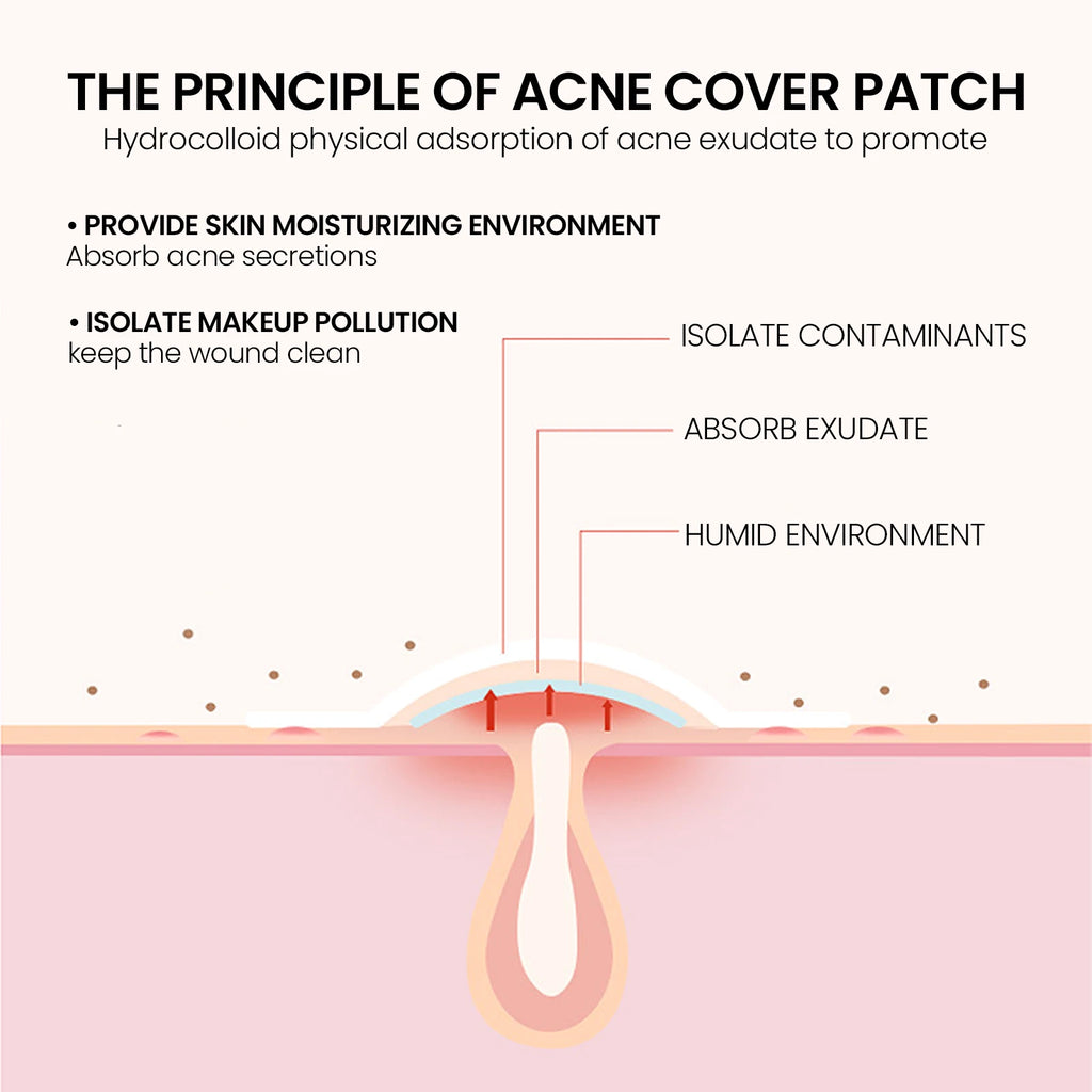 200Pcs Repair Acne Patch Fade Blemishes Pimple Marks Closed Acne Blemishes Hydrocolloid Star Shaped Cover Acne Pimple Patch Zpaxo