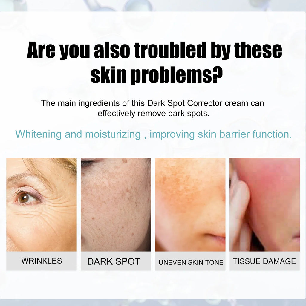 Freckle Whitening Cream Nicotinamide Fade Dark Spot Blemish Acne Mark Brightening Lightening Pigmentation Correction Cream Zpaxo