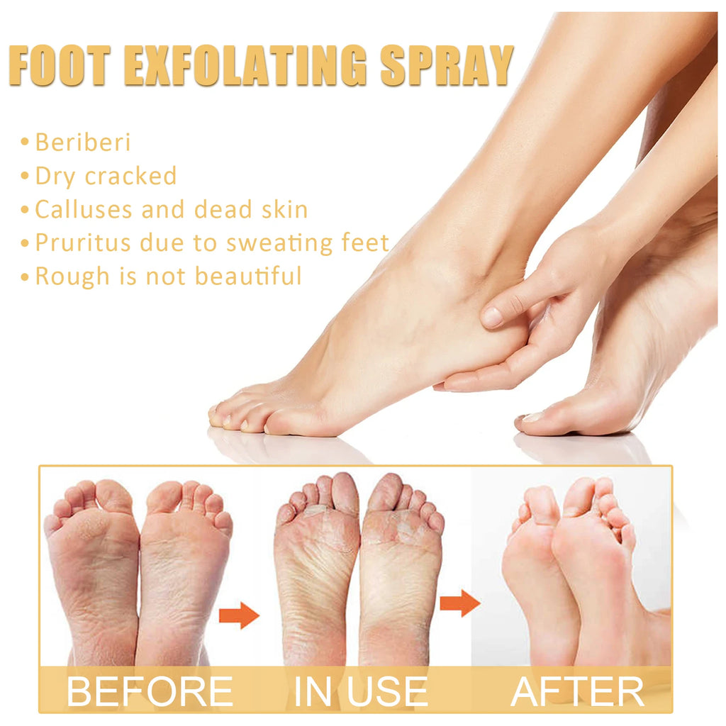 Foot Callus Remover Spray Quickly Soften Calluses Exfoliation Dry Zpaxo