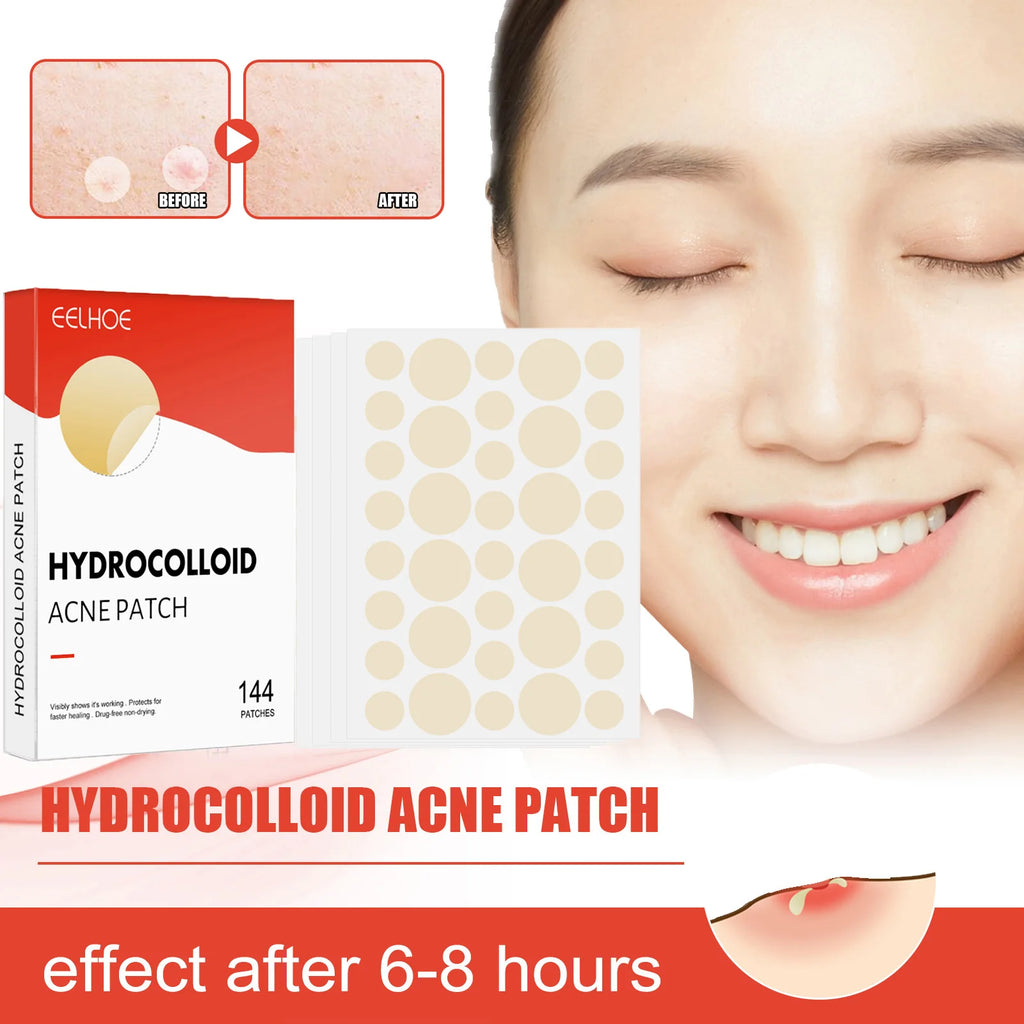 Hydrocolloid Acne Patches 144pcs | Invisible Pimple Spot Treatment Acne Pimple Patches Zpaxo