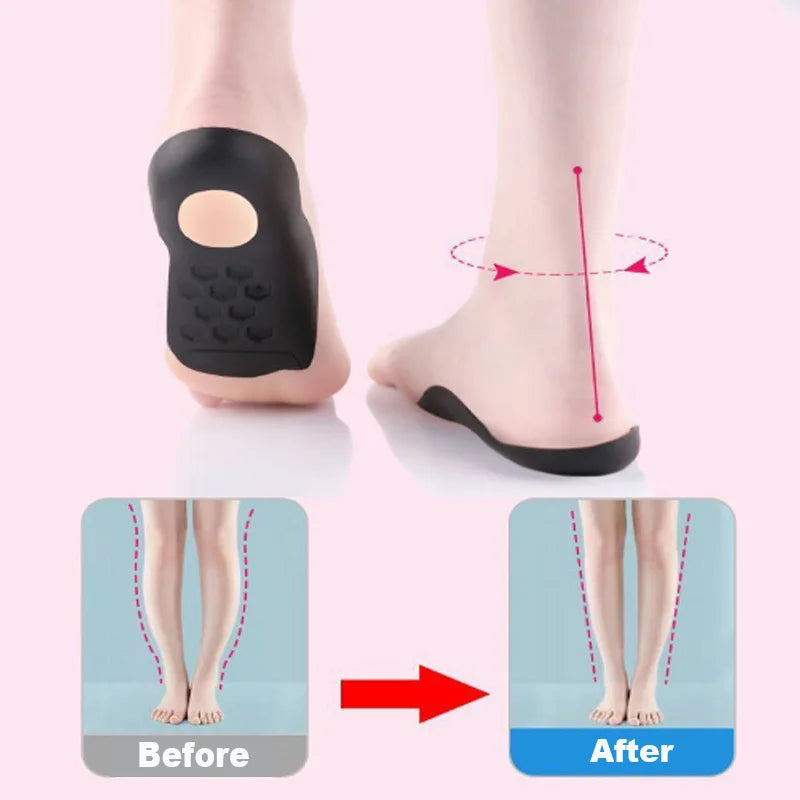 1Pair Orthopedic Insoles Flat Feet Arch Insole Walking Pad Support