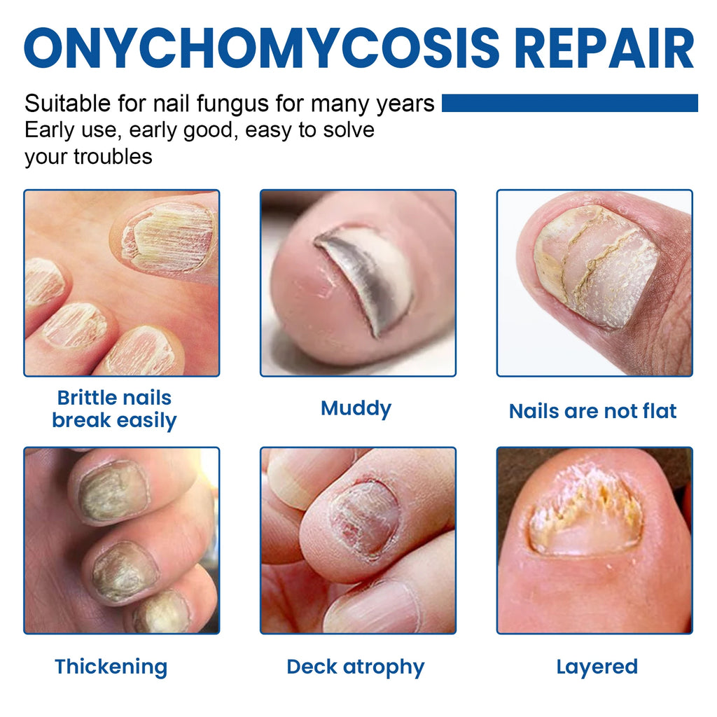 Nail Repair Patches – Fungus, Ingrown & Paronychia Treatment 60pcs Nail Treatment Patch Zpaxo