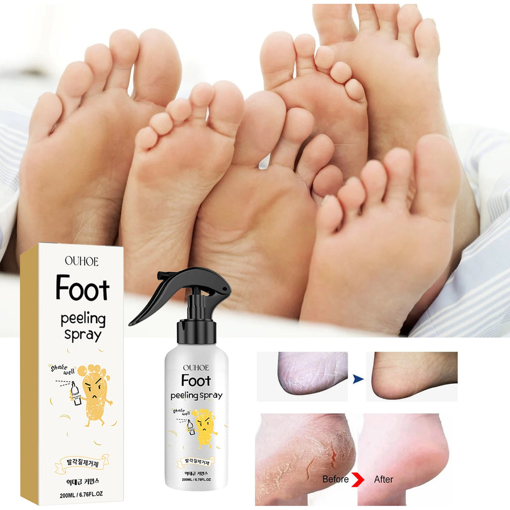 Foot Callus Remover Spray Quickly Soften Calluses Exfoliation Dry Zpaxo