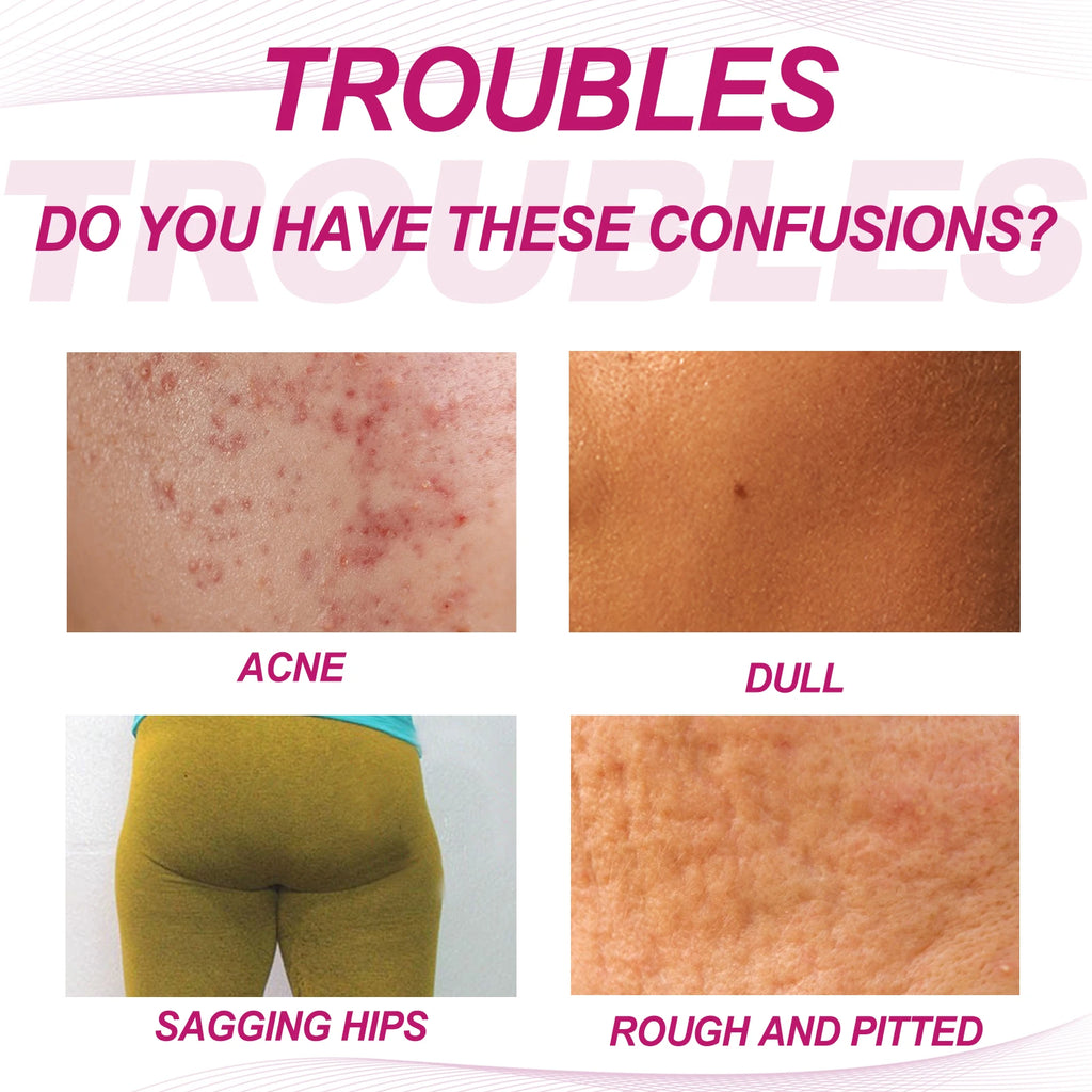 Eelhoe Butt & Thigh Acne Cream – Brighten & Clear Skin Body Acne Cream Zpaxo