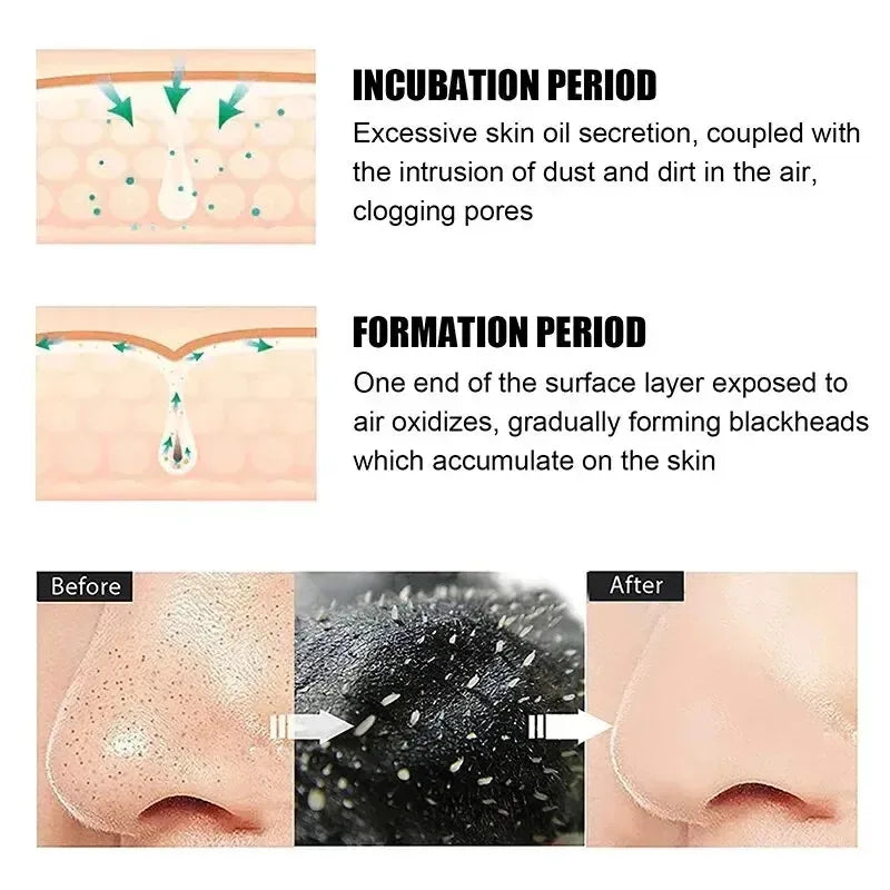 Nose Strips Blackhead & Whitehead Remover – Pore Cleansing Patches