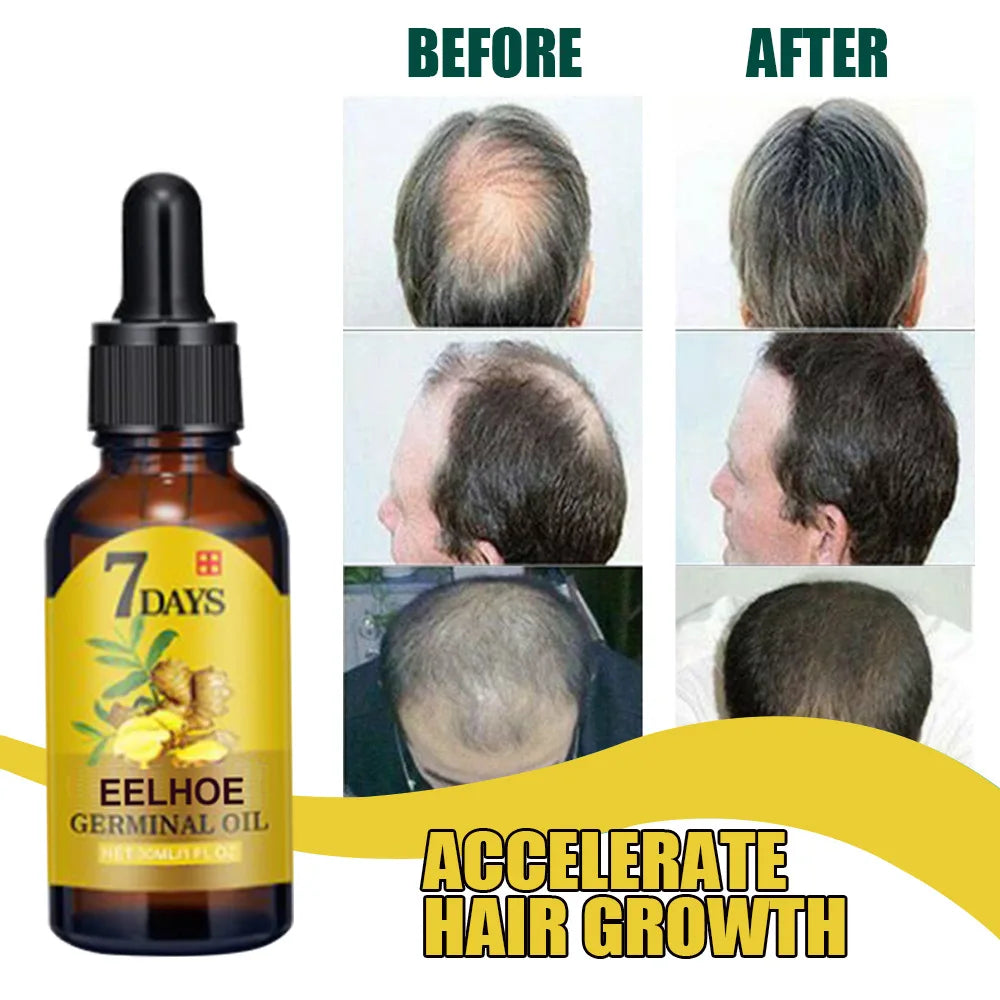 EELHOE Ginger Hair Growth Oil for Scalp Massage Hair Follicle Treatment Hair Care Germinal Essence for Regrowth & Loss Treatment Zpaxo