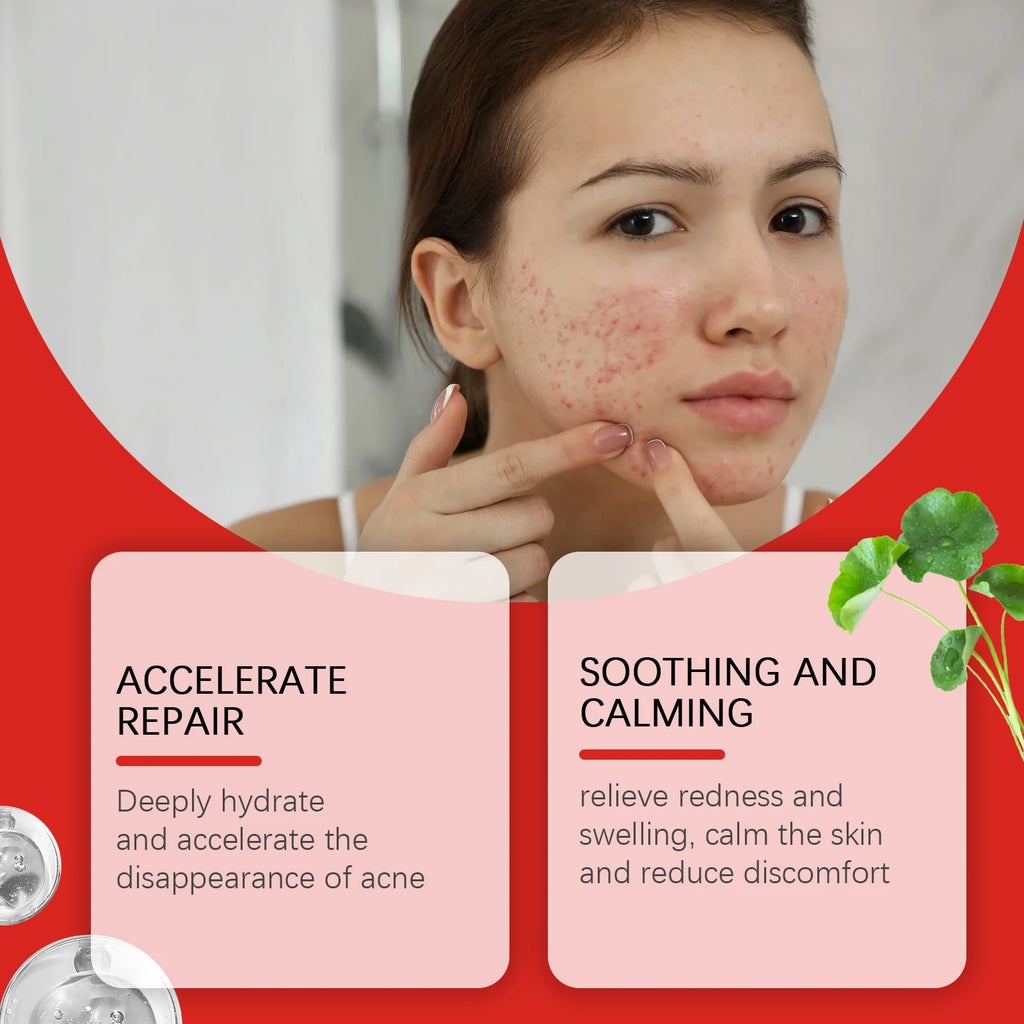 240Pcs Salicylic Acid Acne Pimple Patches Colorful Round/Heart/Flower/Star Shape Acne Removal Skin Care Stickers Covering Zits Zpaxo