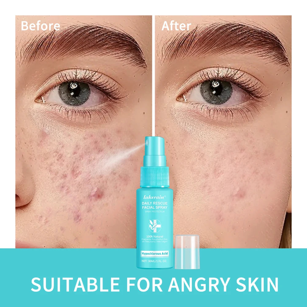 Hypochlorous Acid Facial Spray – Soothing Toner Sensitive Skin Facial Toner Spray Zpaxo