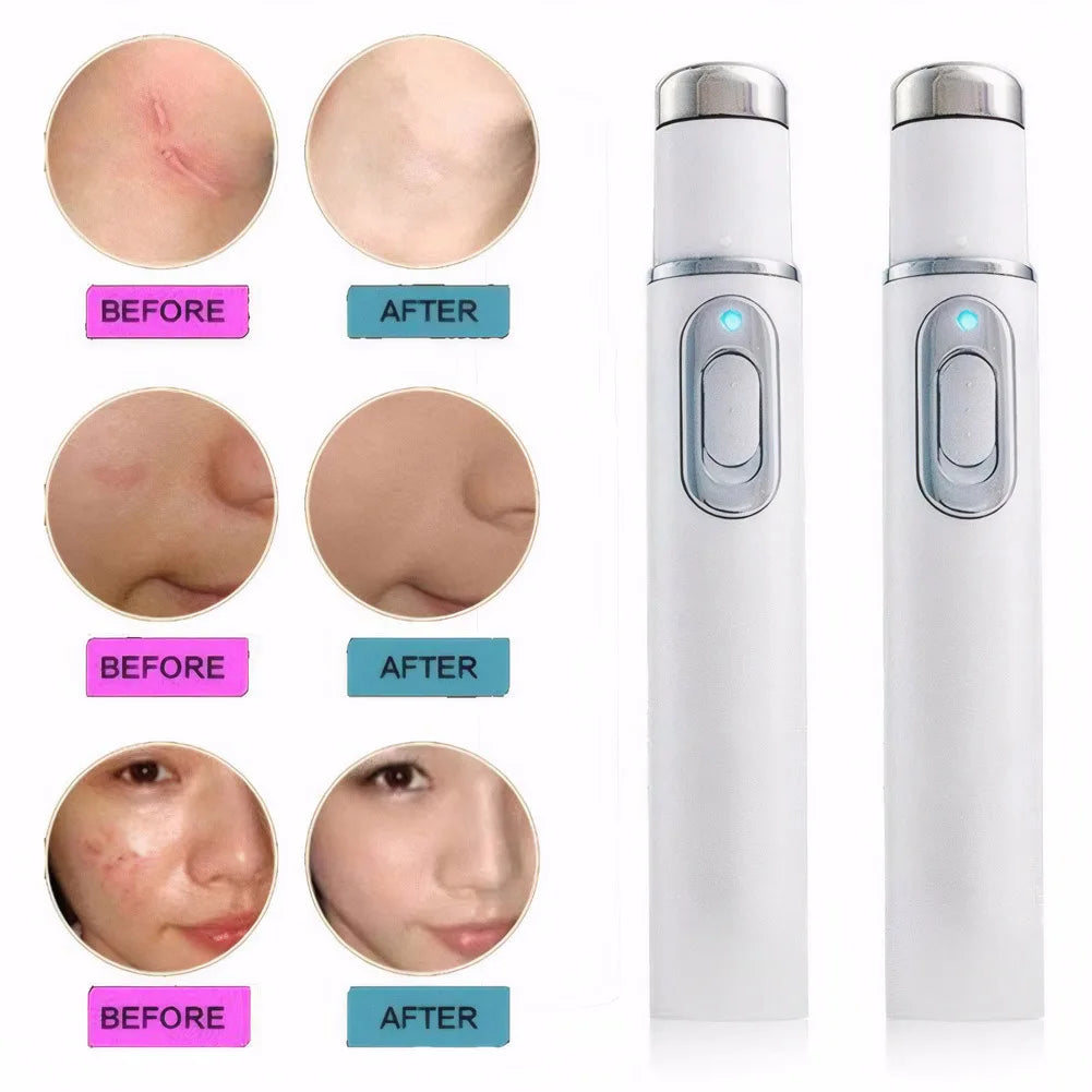 Blue Light Therapy Acne Pen Eye Massager Eye Beauty Device for Relax Eye Dark Circles Eye Bags Puffiness Zpaxo