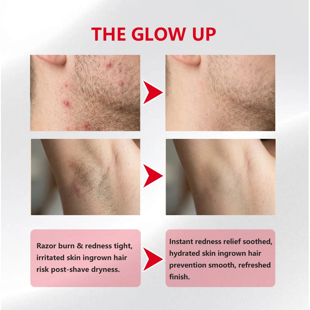 Ingrown Hair Pads Aftershave Treatment Pads to Help Prevent Razor Bumps for Men & Women - Exfoliate Underarms & Bikini Area Zpaxo