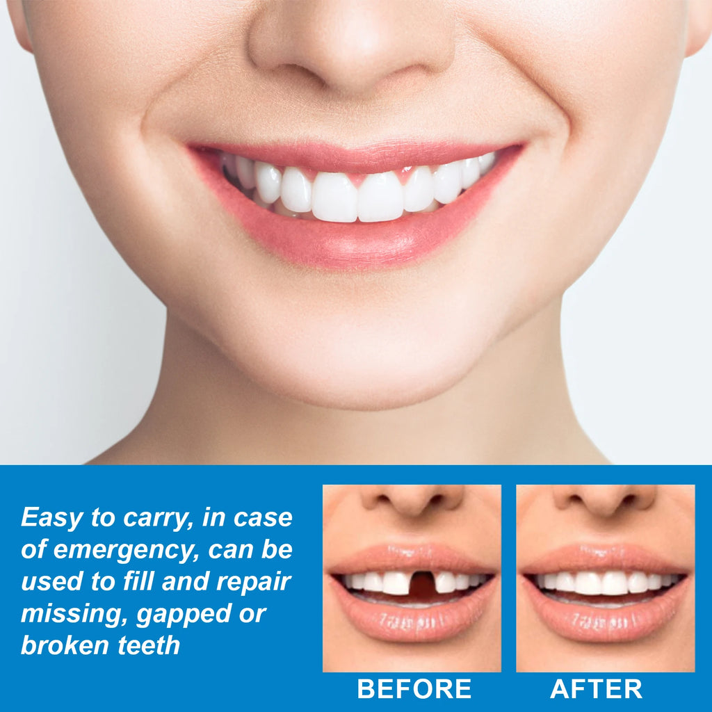 Temporary Tooth Repair KitFor Halloween makeup, fix gaps, cavities and broken teeth with moldable dental resin Zpaxo