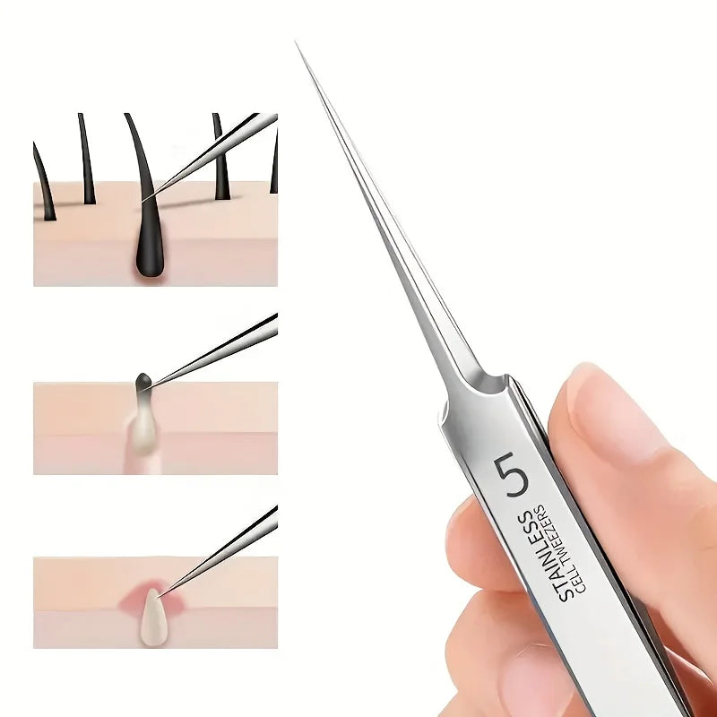 5pcs Stainless steel tweezers for powerful blackhead removal, suitable for all skin types Zpaxo