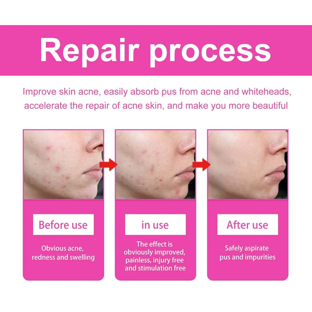 Pimple Patches for Face Cute Butterfly Shaped Acne Patches Hydrocolloid Cute Zit Stickers Parches Para Acne Zpaxo