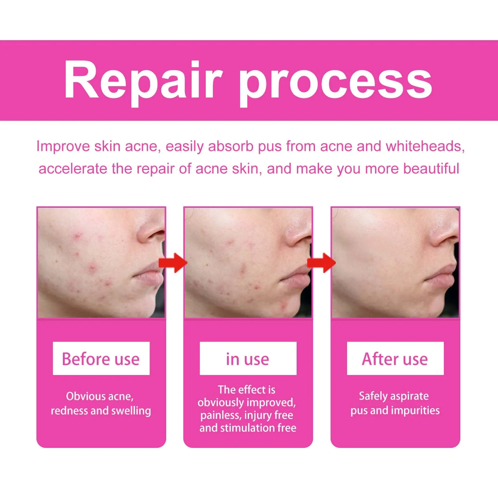 Pimple Patches for Face Cute Butterfly Shaped Acne Patches Hydrocolloid Cute Zit Stickers Parches Para Acne Zpaxo