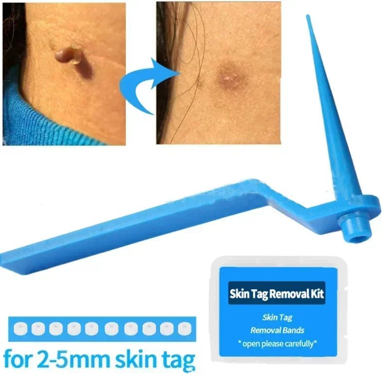 1 Set Skin Tag Removal Kit Skin Mole Wart Remover Micro Band Skin Tag Removal Kit Tag Treatment Tools Set with Cleansing Swabs Zpaxo