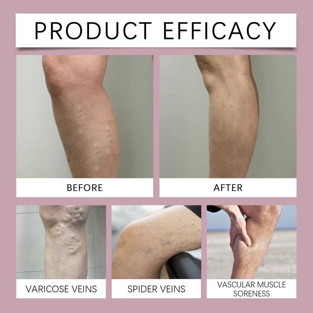 OUHOE Algen Salbe Varicose Vein Relief Cream Improve Venous Tension Accelerate Blood Circulation Deeply Moisturize The Skin Zpaxo