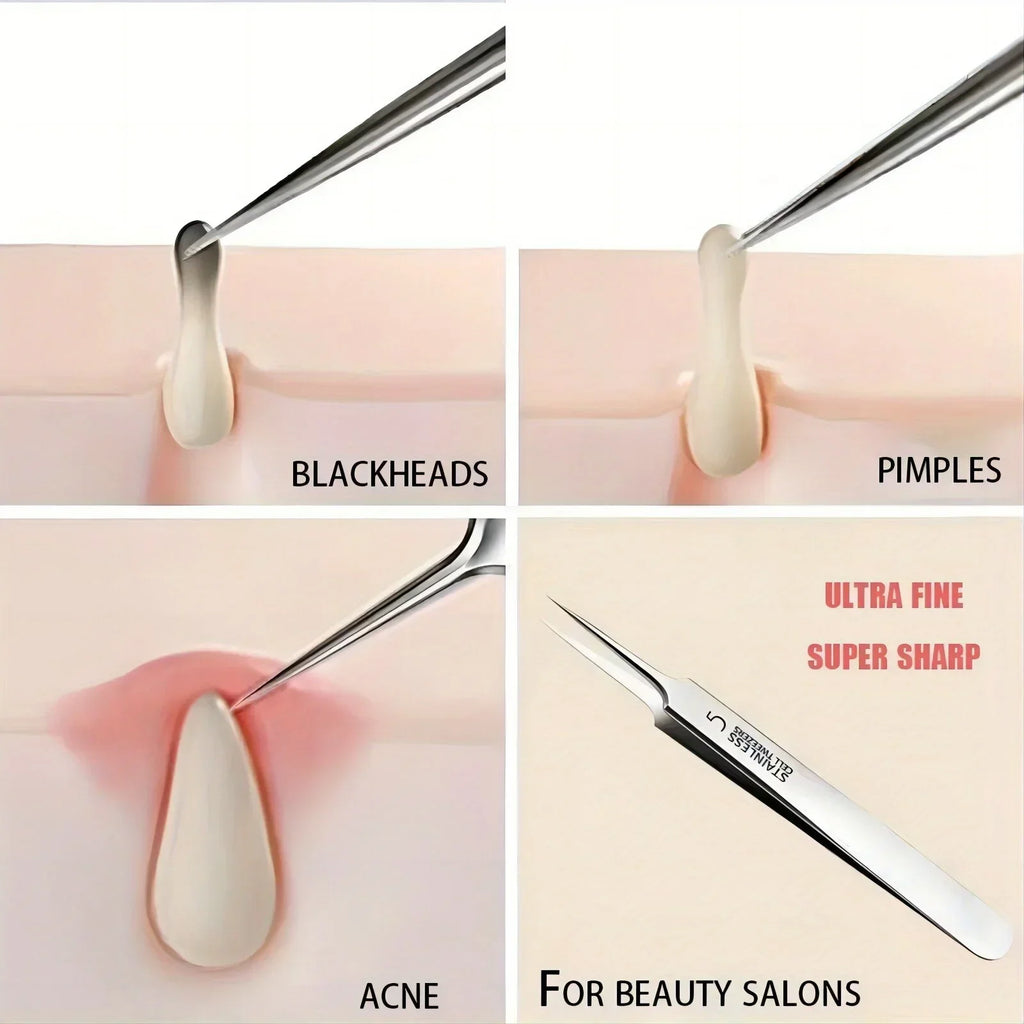 3PCS Easy-To-Use Stainless Steel Acne Extractor Set - Hypoallergenic Beauty Tweezers For Clear Skin, Perfect For Beginners Zpaxo