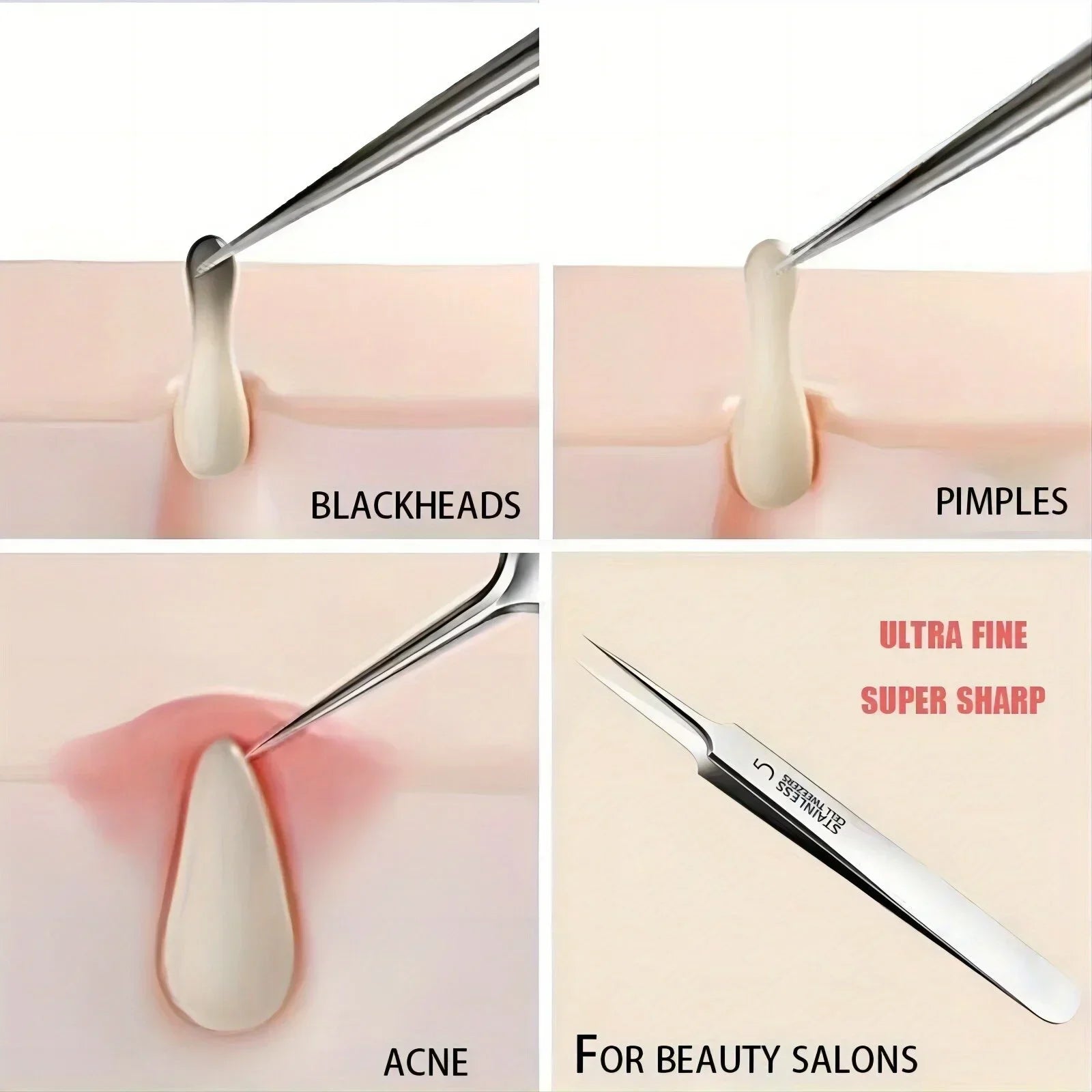 3PCS Easy-To-Use Stainless Steel Acne Extractor Set - Hypoallergenic Beauty Tweezers For Clear Skin, Perfect For Beginners Zpaxo