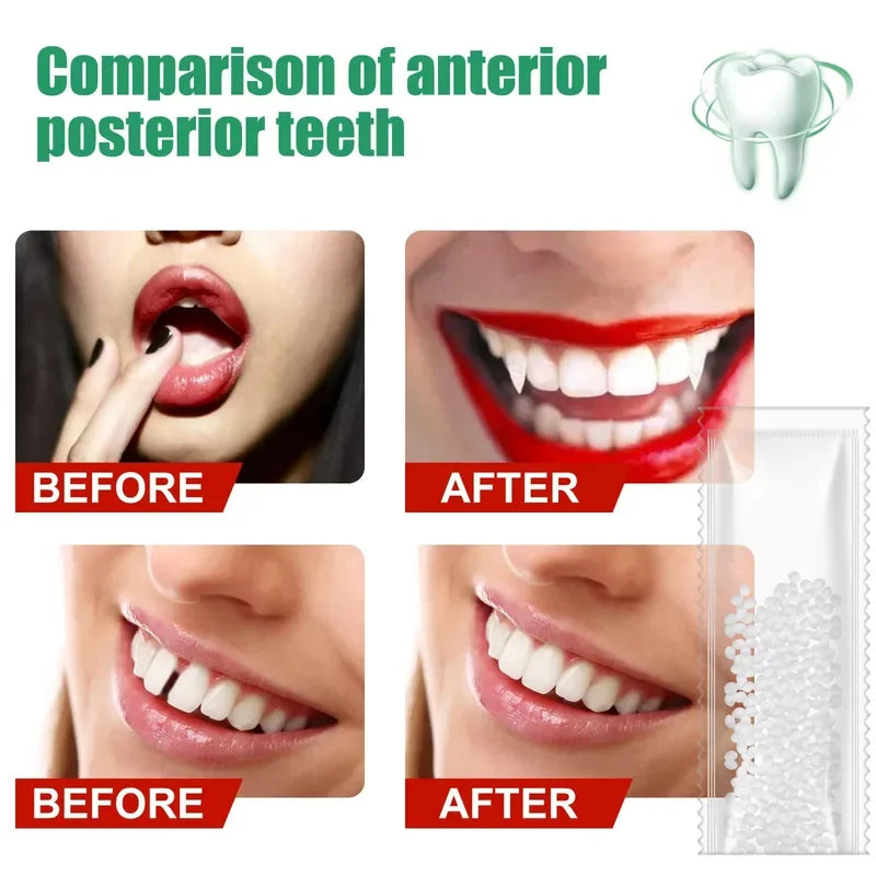 Temporary Tooth Repair Kit – Moldable Resin Dental Adhesive