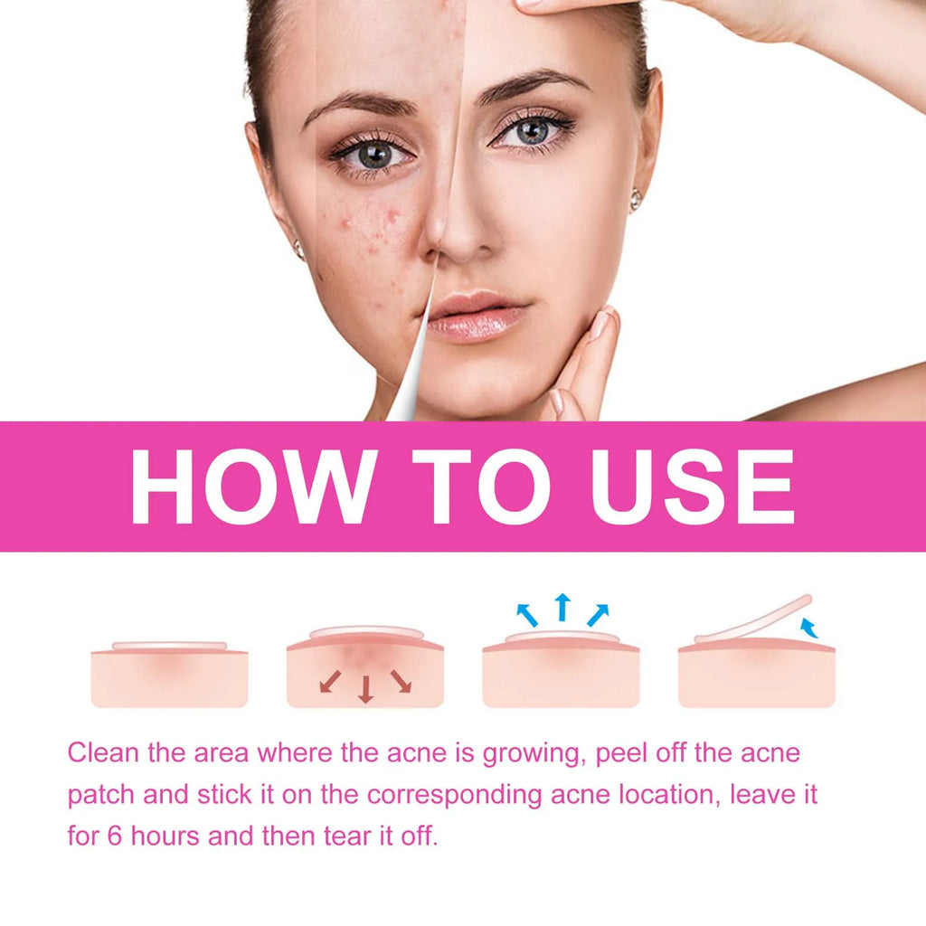 Pimple Patches for Face Cute Butterfly Shaped Acne Patches Hydrocolloid Cute Zit Stickers Parches Para Acne Zpaxo