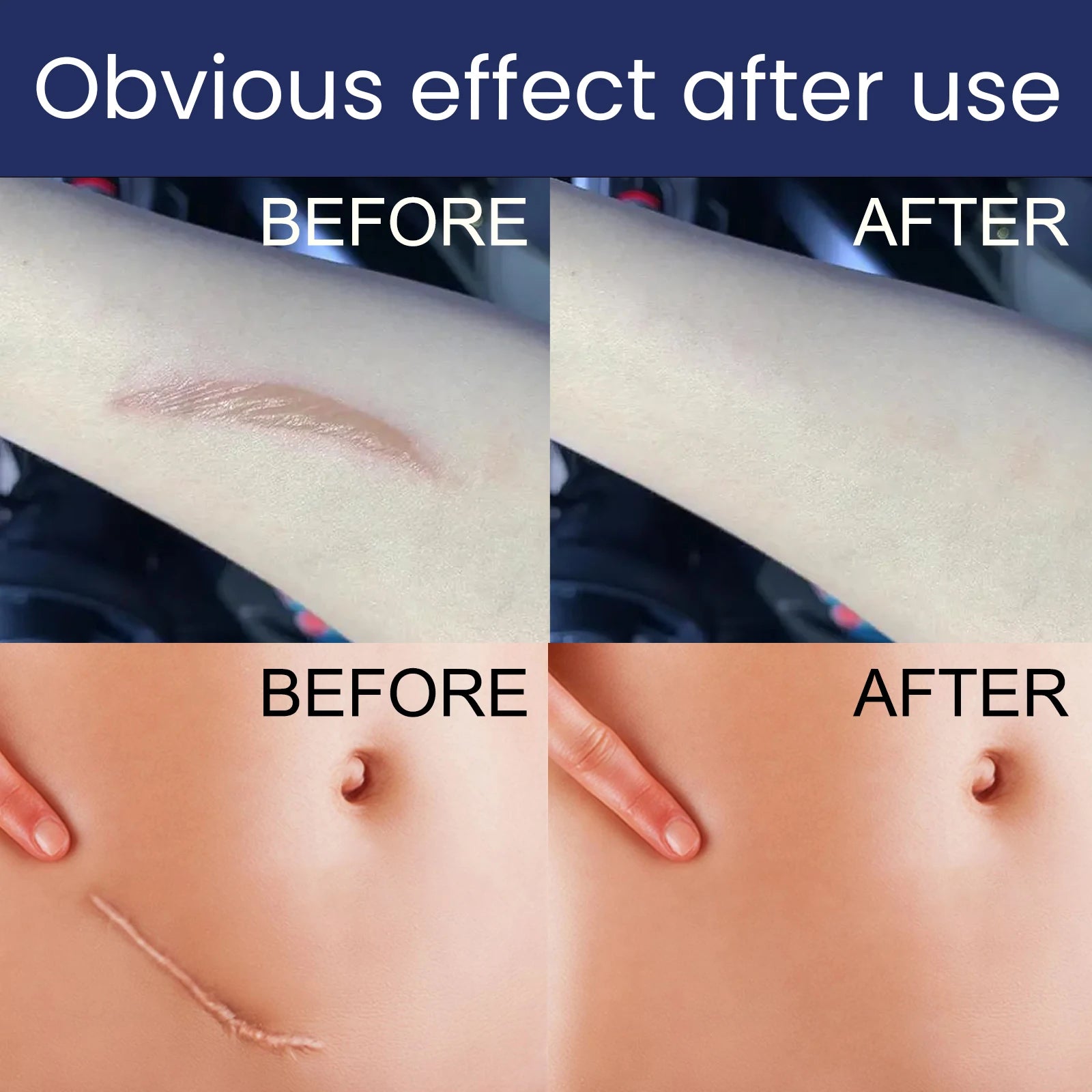 EELHOE Silicone Skin Scar Gel Retinol Niacinamide Scars Stretch Marks Burn Marks Deeply Nourish Skin Reduce Redness Swelling 30g Zpaxo