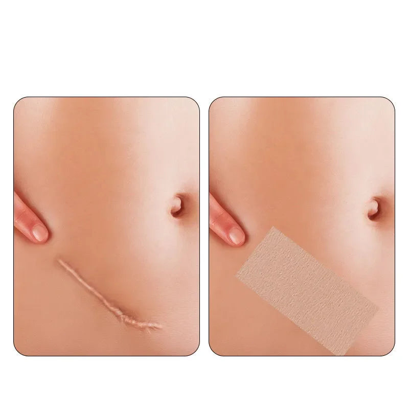 Invisible Skin Tattoo Patches Natural-looking Birthmark Concealer