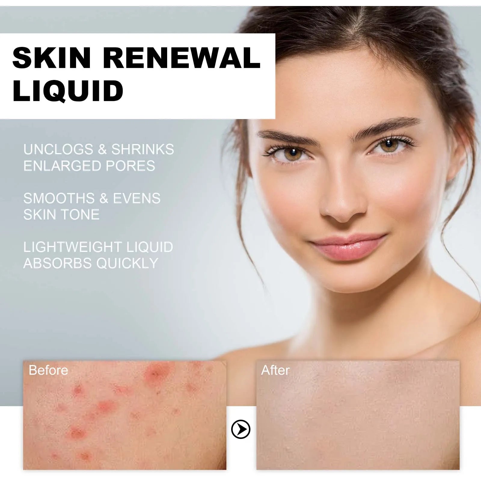 2% BHA Salicylic Acid Acne Serum – Pores, Dark Spots & Glow BHA Acne Serum Zpaxo