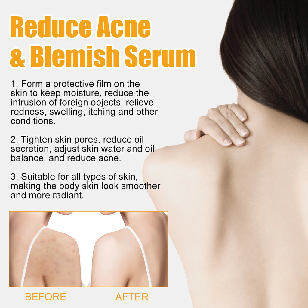 Acn-e Treatm-ent Serum Body Fade Sp-ots Relieve Pigm-entation Moisturizing Smooth Facial Skin Buttock Ac-ne Remover Essence 50ml Zpaxo