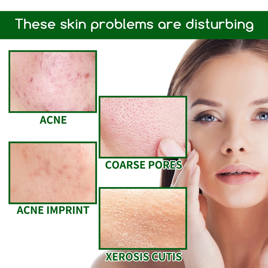 Salicylic Acid Face Serum – Acne, Pores & Oil Control 30ml Anti-Acne Face Serum Zpaxo