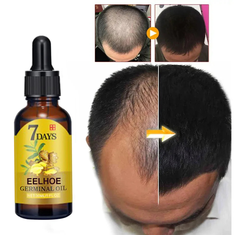 EELHOE Ginger Hair Growth Oil for Scalp Massage Hair Follicle Treatment Hair Care Germinal Essence for Regrowth & Loss Treatment Zpaxo