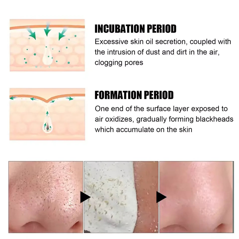 Blackhead Removal Nasal Patch - Nasal Cleansing Mask, Deep Cleansing, Gentle, Suitable for Both Men and Women for Removing Black Zpaxo