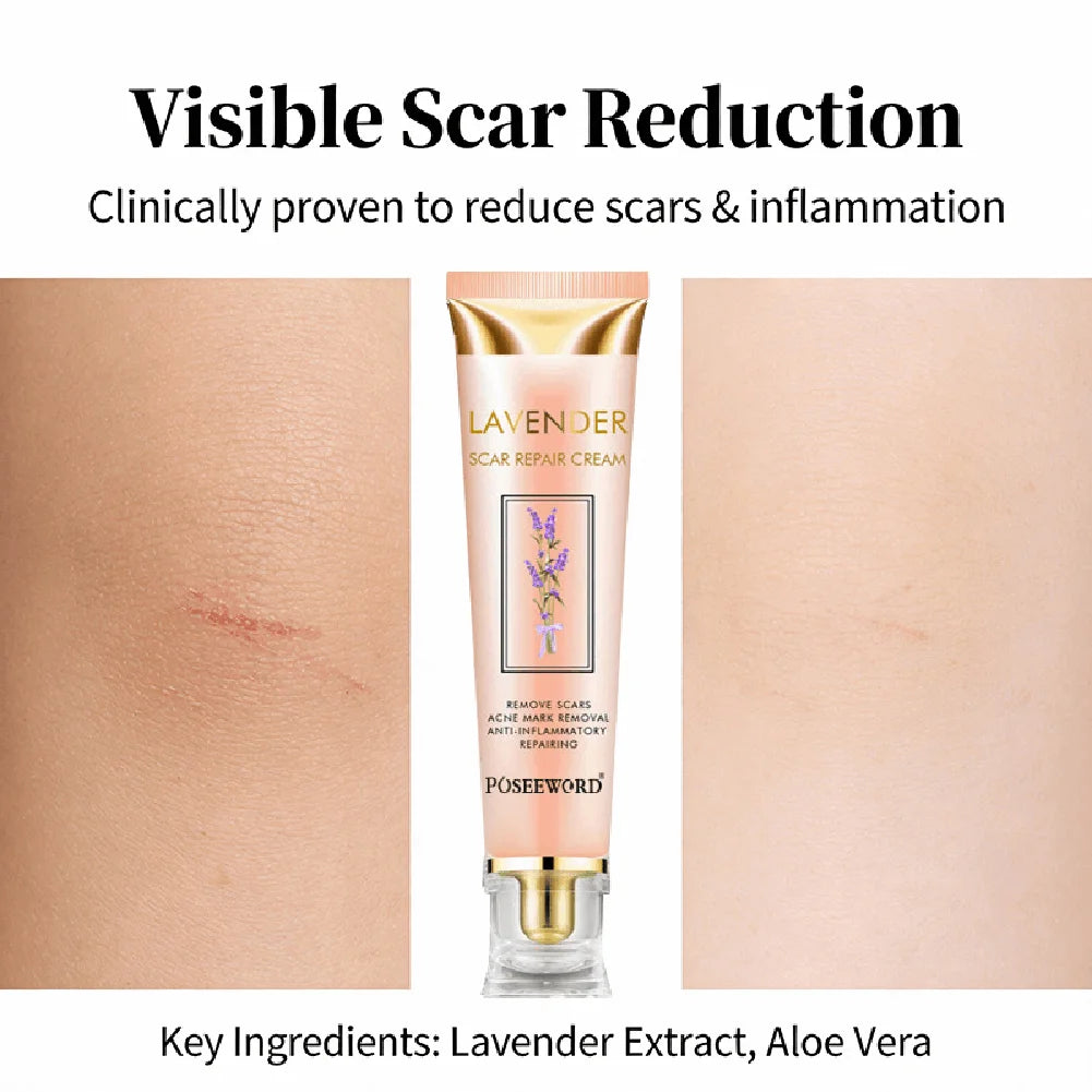 Lavender Scar Repair Cream – Fades Acne Marks & Smoothes Skin Scar Repair Cream Zpaxo