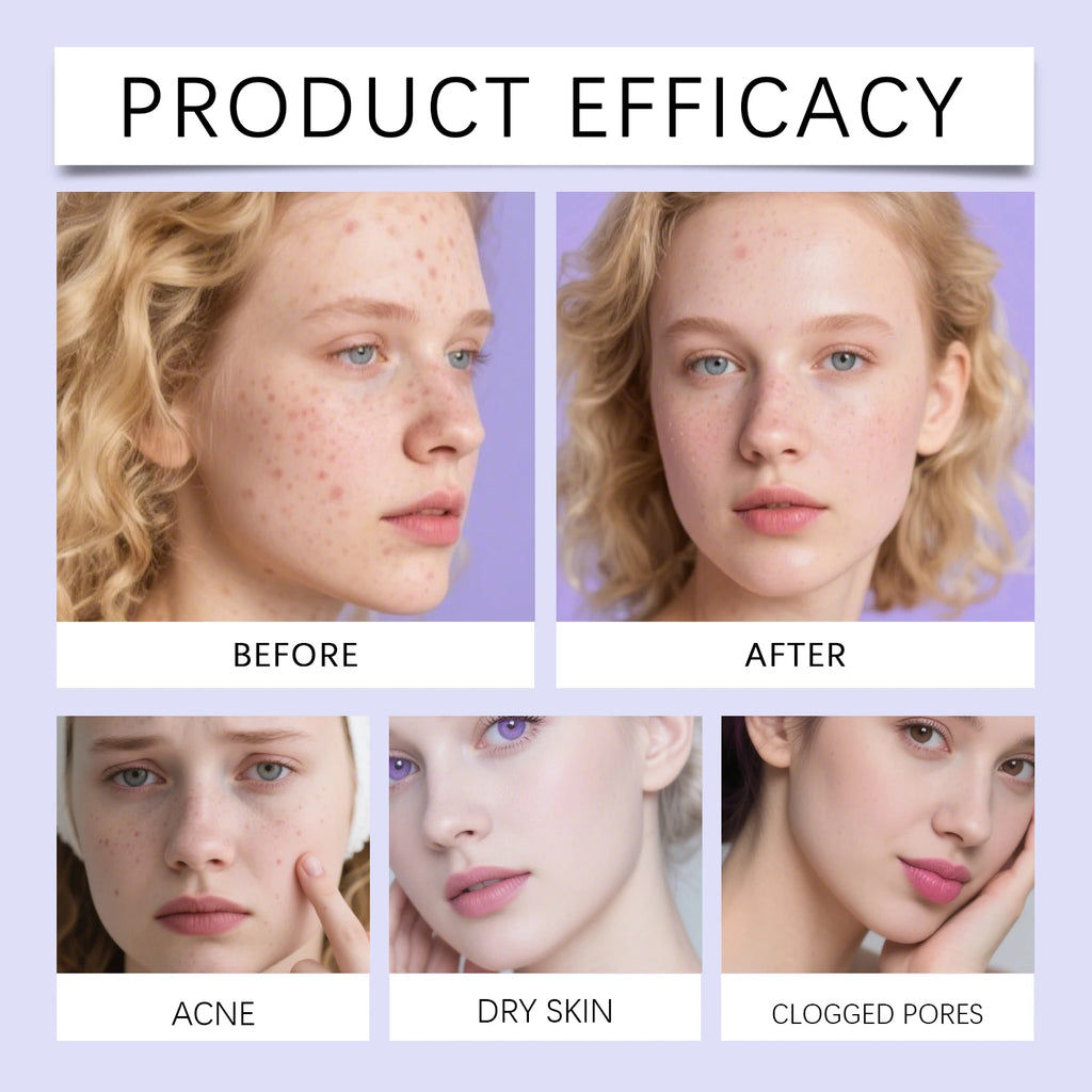 Acne Patches 360 Pcs Salicylic Acid Allantoin Hydrocolloid Invisible Pimple Patches for Face Gentle Daily Spot Treatment Zpaxo