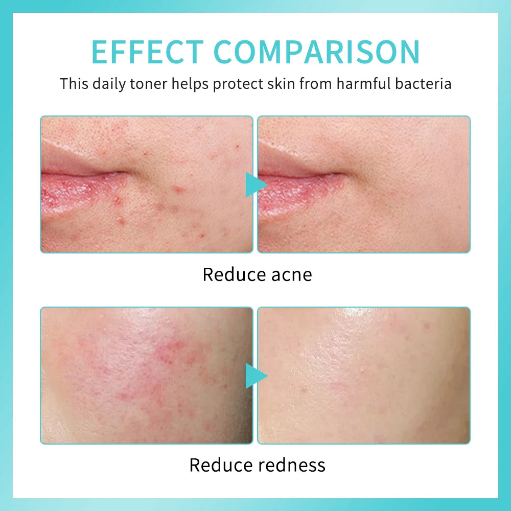 Hypochlorous Acid Facial Spray – Soothing Toner Sensitive Skin Facial Toner Spray Zpaxo