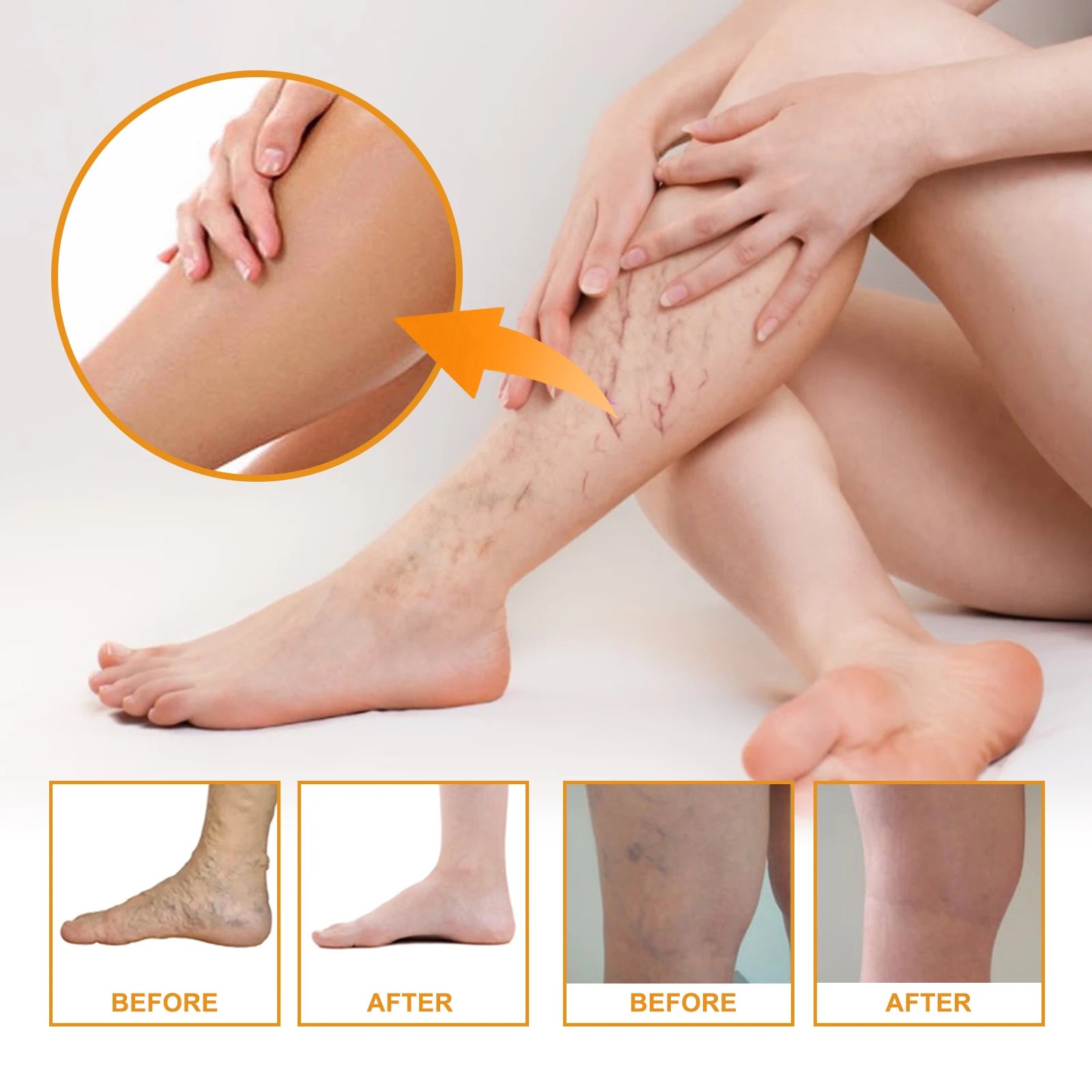 Vitamin K Cream for Varicose Veins, Spider Veins & Leg Relief Vitamin K Skin Cream Zpaxo