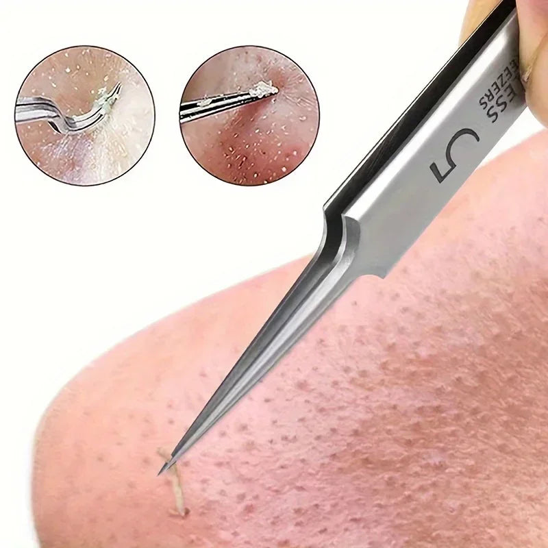 3PCS Easy-To-Use Stainless Steel Acne Extractor Set - Hypoallergenic Beauty Tweezers For Clear Skin, Perfect For Beginners Zpaxo