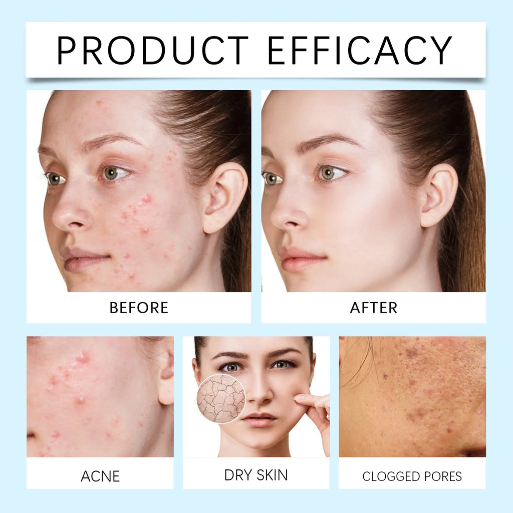 Acne Patches 120 Pcs Allantoin Salicylic Acid Hydrocolloid Multi Shape Pimple Patches for Face Blackhead Care Skin Elasticity Zpaxo
