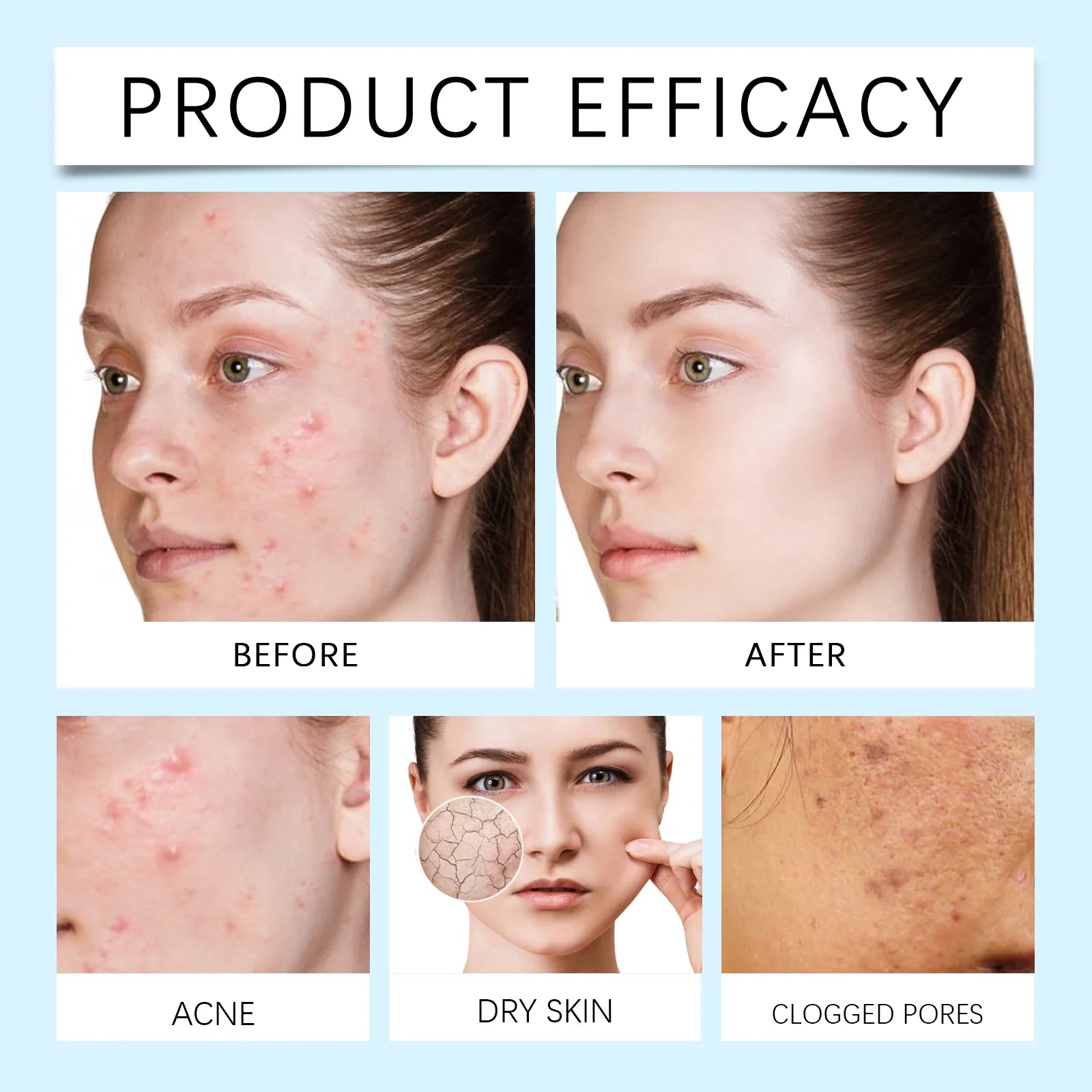 Acne Patches 120 Pcs Allantoin Salicylic Acid Hydrocolloid Multi Shape Pimple Patches for Face Blackhead Care Skin Elasticity Zpaxo