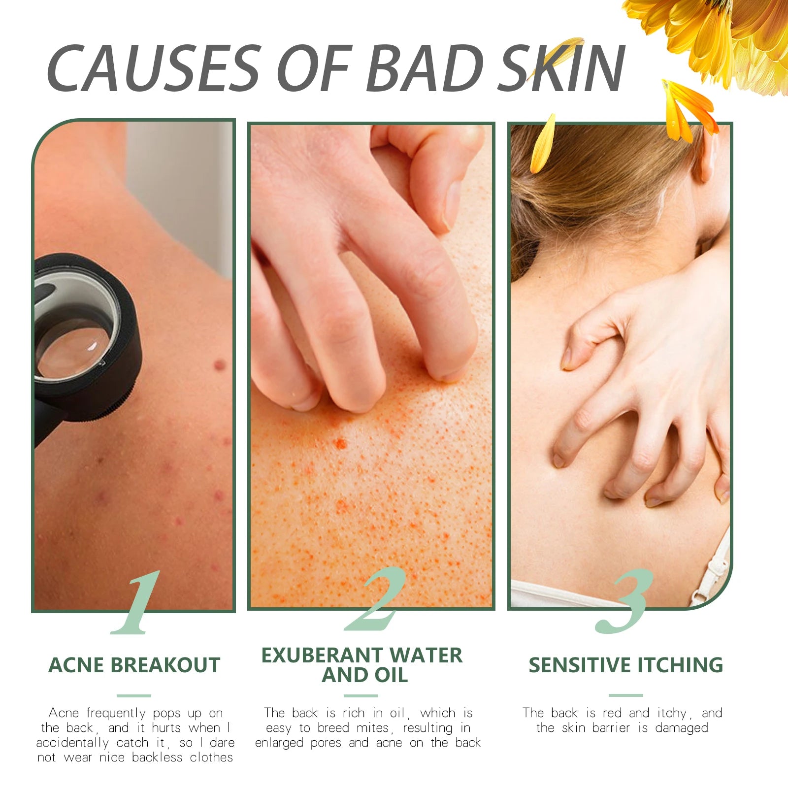 Chicken Skin Repair Cream Curing Body Keratosis Pilaris Remove Acne Sp-ot Rough Bumpy Pore Moisturizing Smooth Whi-tening Lotion Zpaxo