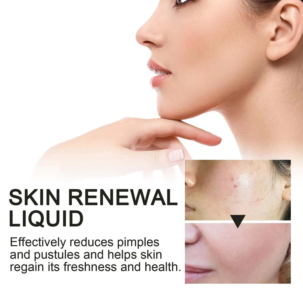 2% BHA Salicylic Acid Acne Serum – Pores, Dark Spots & Glow BHA Acne Serum Zpaxo