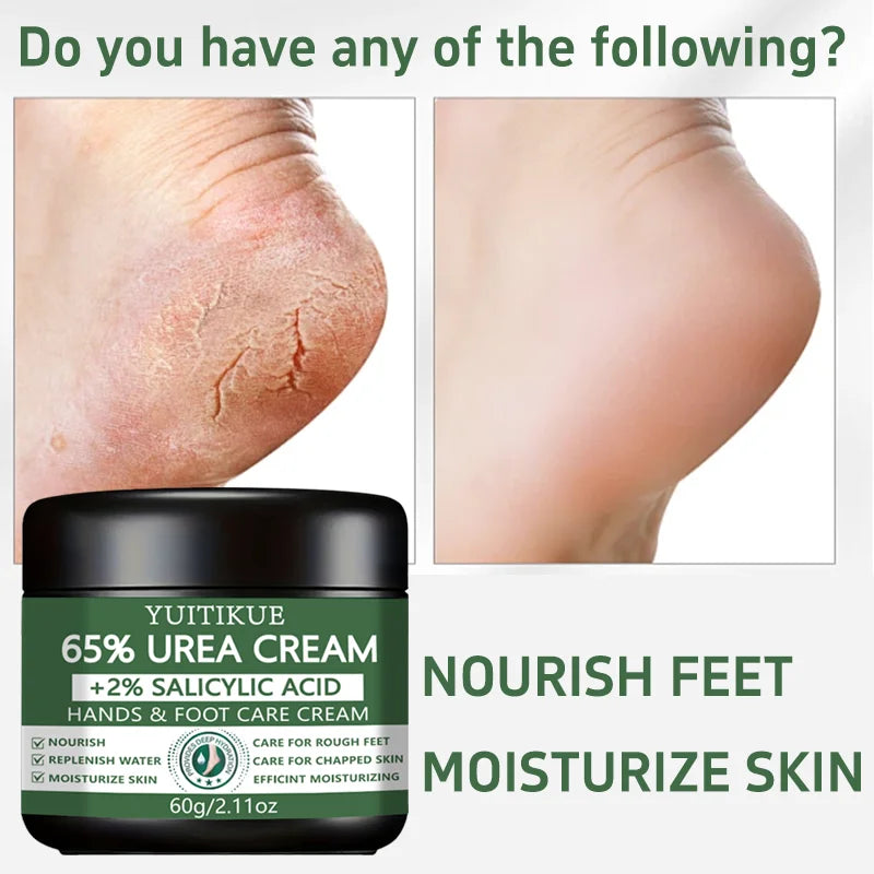 YUITIKUE 65% Urea Foot & Hand Cream – Cracked Skin Repair 60g Foot & Hand Cream Zpaxo