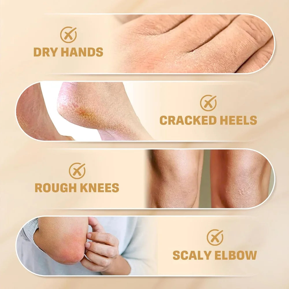 Urea Cream 60g – Cracked Heels, Dry Hands & Rough Skin Repair Foot & Skin Cream Zpaxo