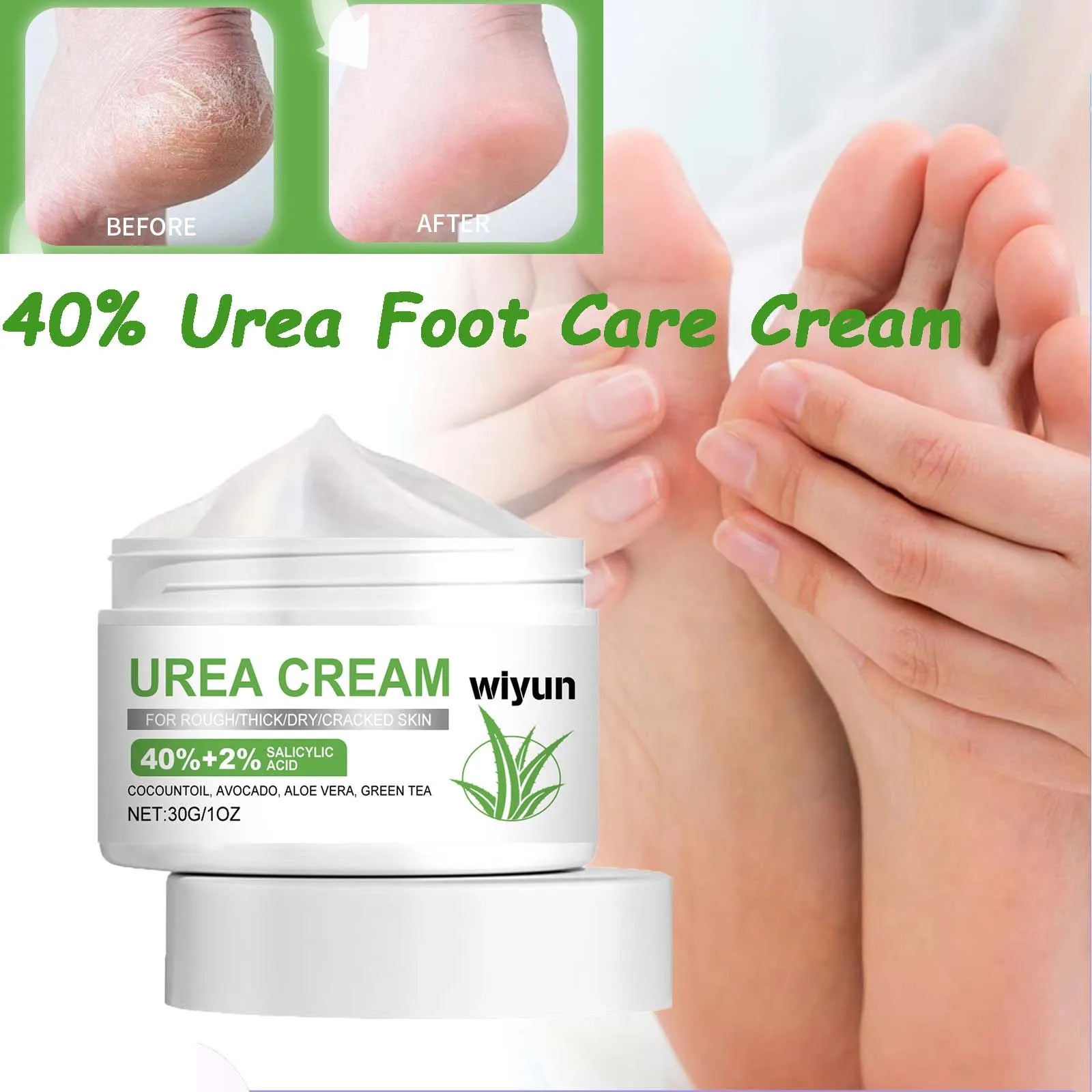 WIYUN 40% Urea Foot Cream – Cracked Heels & Callus Repair Urea Foot Cream Zpaxo