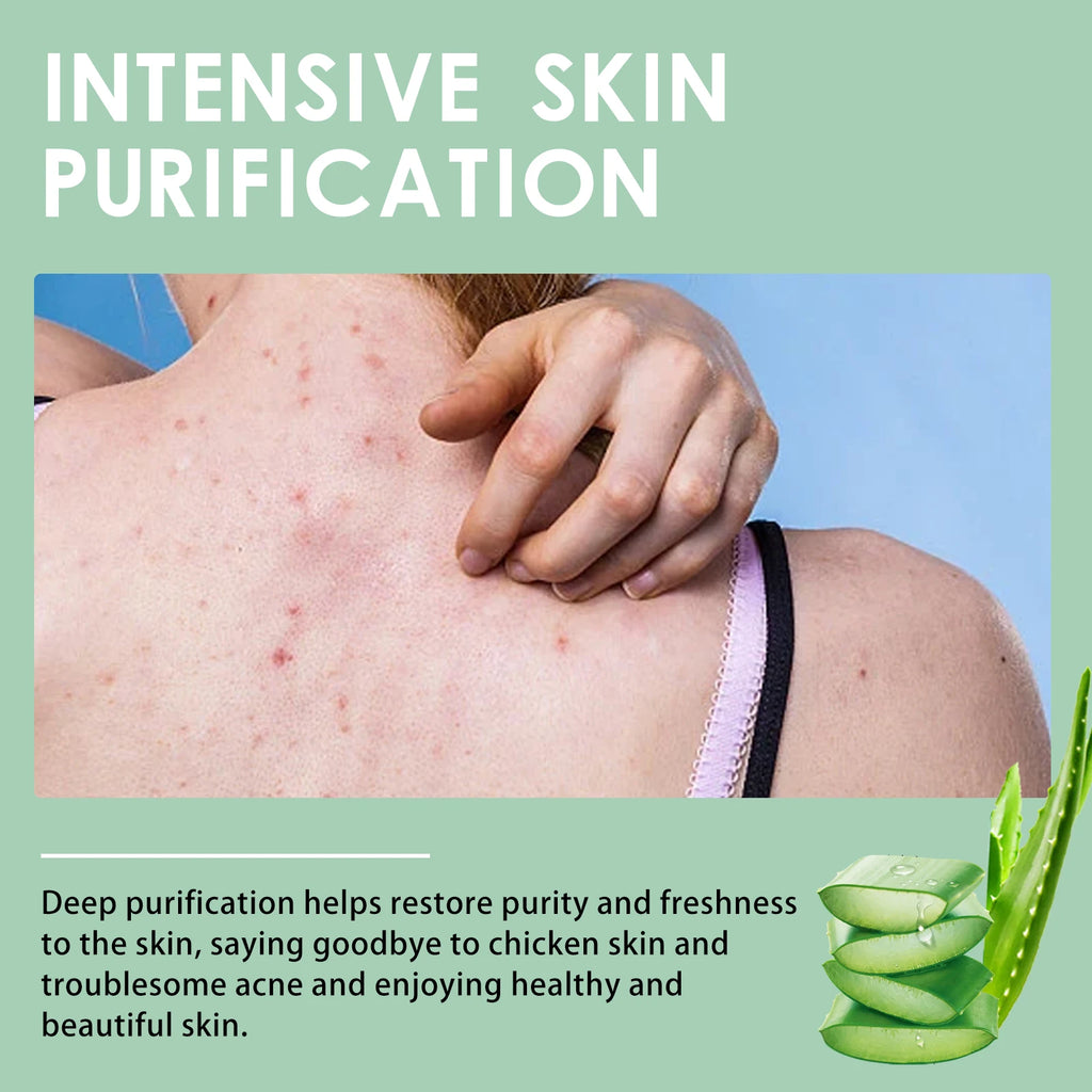 Chicken Skin Repair Cream Curing Body Keratosis Pilaris Remove Acne Sp-ot Rough Bumpy Pore Moisturizing Smooth Whi-tening Lotion Zpaxo