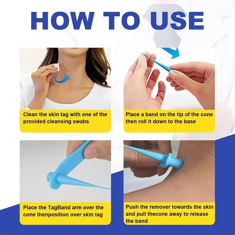 1 Set Skin Tag Removal Kit Skin Mole Wart Remover Micro Band Skin Tag Removal Kit Tag Treatment Tools Set with Cleansing Swabs Zpaxo