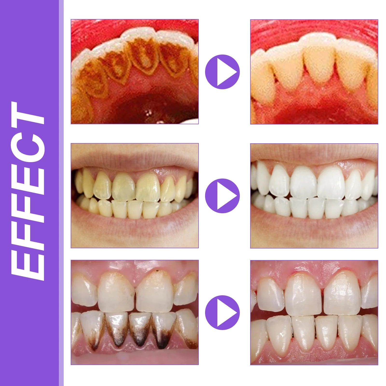EELHOE Smiles Bright White Refining Serum Teeth Whitening Mousse Mild Ingredients Nano-Hydroxyapatite Xylitol Easy To Use 30ml Zpaxo