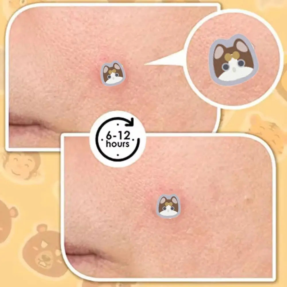 220PCS Cute Hydrocolloid Pimple Patches – Cat Acne Spot Stickers Acne Pimple Patches Zpaxo